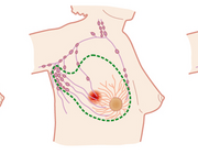 Inflammatoir mammacarcinoom